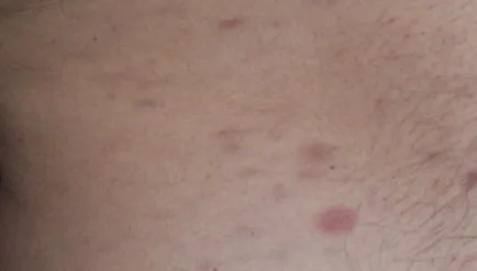 patch-uri intunecate de sub subsuoară cauzele și modul de a trata (multe poze)