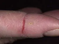 Fisuri de pe mâini și degete (pe bile, sfaturi, falduri între ele), cauzele si tratamentul foto (tampoane) Fisuri de pe mâini și degete (pe bile, sfaturi, falduri între ele), cauze și fotografii de tratament