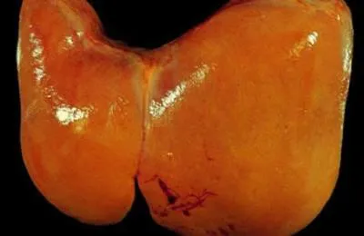 Adăugită cauze hepatice și de tratament, ce să facă în astfel de cazuri