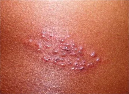 Veziculele cauzele, tratamente, diagnostic, tipuri