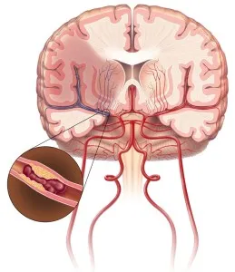 Toate consecințele accident vascular cerebral ischemic - o descriere detaliată a