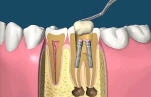 coroana temporară, de ce și modul în care este setat