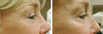 peeling chimic