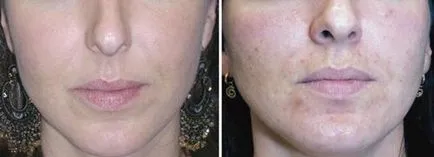 peeling chimic