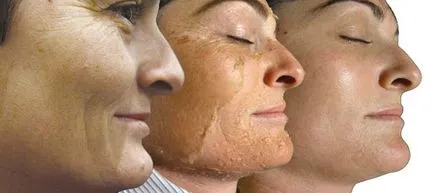 Peeling-ul chimic sunt în special contra