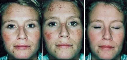 peeling chimic