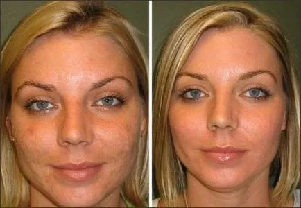 peeling chimic