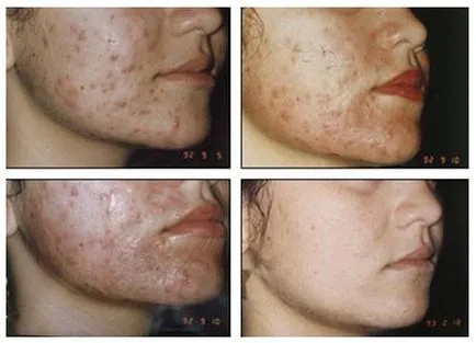 peeling chimic