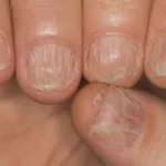 Face ciuperca unghiilor este contagioasă