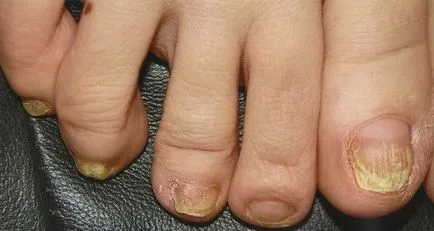 Face ciuperca unghiilor este contagioasă