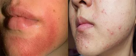 Alergia să se confrunte cu cauze crem, simptome, tratament