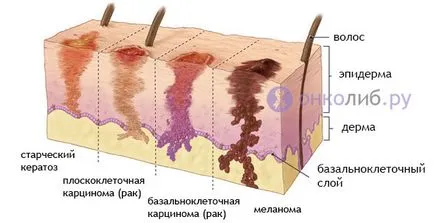 Carcinomul bazocelular a simptomelor pielii, tratarea și eliminarea, foto