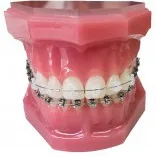 Costul Bretele de instalare, cât de mult costă pentru a pune aparat dentar