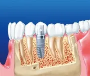 Bretele înainte și după - fotografie dentiști lucrează