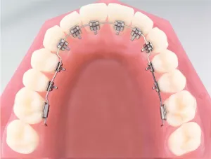 Costul Bretele de instalare, cât de mult costă pentru a pune aparat dentar