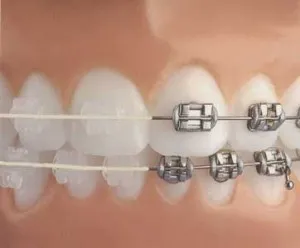 Costul Bretele de instalare, cât de mult costă pentru a pune aparat dentar