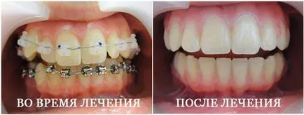 Bretele varietate de sisteme, foto înainte și după instalare