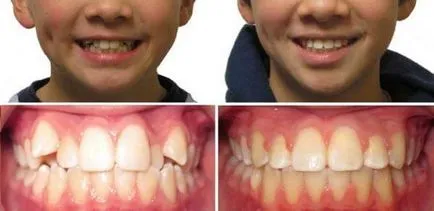 Bretele înainte și după - fotografie dentiști lucrează