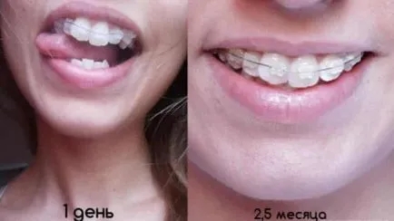 Acolade - fotografii înainte și după alinierea malocluziei (foto) Acolade - fotografii înainte și după alinierea malocclusion