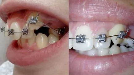 Acolade - fotografii înainte și după alinierea malocclusion (mușcătura) Acolade - fotografii înainte și după alinierea malocclusion