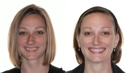 Bretele înainte și după - fotografie dentiști lucrează