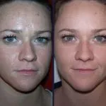 Ce este de migdale indicații și contraindicații, peeling prețurile (înainte și după fotografii) (migdale) Ce este de migdale indicații și contraindicații, peeling prețurile (înainte și după fotografii)