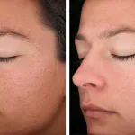 Ce este de migdale indicații și contraindicații, peeling prețurile (înainte și după fotografii) (contraindicații) Ce este de migdale indicații și contraindicații, peeling prețurile (înainte și după fotografii)