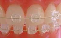 Până la ce vârstă poate pune aparat dentar de revizuire detaliată (a) Până la ce vârstă poate pune aparat dentar prezentare detaliată