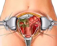 Dermoid cauze chist ovarian, simptome și tratament, consecințele chirurgiei (chist) Dermoid cauze chist ovarian, simptome și tratament, consecințele chirurgie