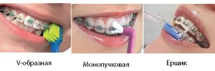 Copiii acolade costul de instalare, clasificare - atunci când a pus aparat dentar pentru copii (atunci când copii a pus aparat dentar) Copiii acolade costul de instalare, clasificare - atunci când a pus aparat dentar pentru copii
