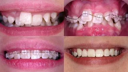 Copiii acolade costul de instalare, clasificare - atunci când copii a pus aparat dentar (aparat dentar pus copilul) Copiii acolade costul de instalare, clasificare - atunci când a pus aparat dentar pentru copii