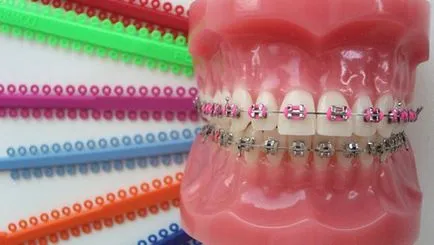 Copiii acolade costul de instalare, clasificare - atunci când copii a pus aparat dentar (instalare) Copiii acolade costul de instalare, clasificare - atunci când a pus aparat dentar pentru copii