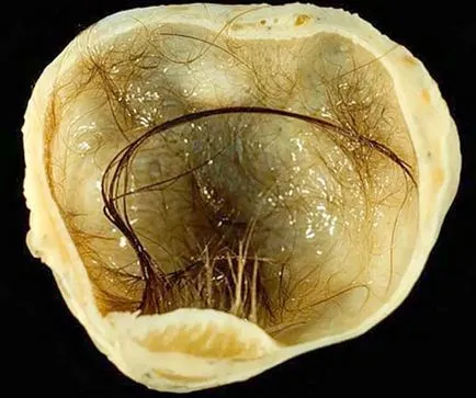 Dermoid cauze chist ovarian, simptomele și efectele benefice ale tratamentului în cazul funcționării (cauza) Dermoid cauze chist ovarian, simptome și tratament, consecințele chirurgie