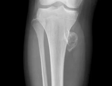 Exostosis (oase și cartilaje creșteri), ceea ce este, un tratament (creșteri) Exostosis (oase și cartilaje excrescențe) ce este, tratament