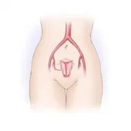 Flebolity in pelvis si picioare cauze, tratament, simptomele (flebolity) Flebolity în pelvis și picioare cauze, tratament, simptome