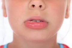 Herpes pe buze - cauze, simptome si tratamentul herpesului (semne) Herpes pe buze - cauze, simptome si tratamentul herpesului