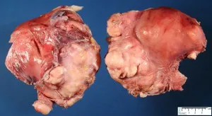 Fibrosarcom de oase, țesut moale, piele și de sân fotografie, simptome, tratament și prognostic