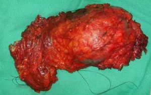 Fibrosarcom fotografie, cauzele bolii, simptome, tratament eficient (simptome) Fibrosarcom fotografie, cauzele bolii, simptome, tratament eficient