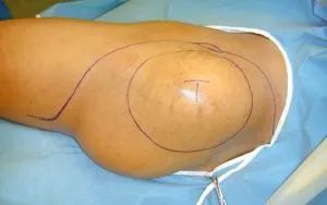 Fibrosarcom fotografie, cauzele bolii, simptome, tratament eficient (simptome) Fibrosarcom fotografie, cauzele bolii, simptome, tratament eficient