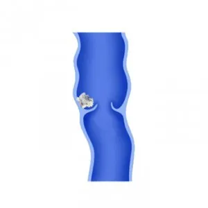 Flebolity in pelvis si picioare cauze, tratament, simptome (cauze) Flebolity în pelvis și picioare cauze, tratament, simptome
