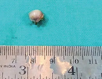 Flebolity in pelvis si picioare cauze, tratament, simptomele (flebolity) Flebolity în pelvis și picioare cauze, tratament, simptome