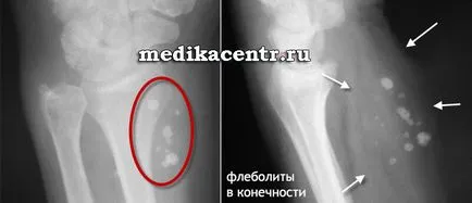 Phlebolith problema flebolity in urologie