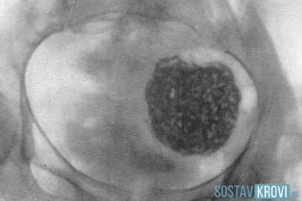 Flebolity cauze, simptome, diagnosticul, prevenirea și tratamentul