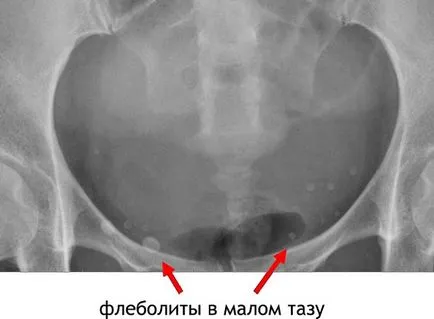 Flebolity (calcifiere venelor la nivelul bazinului, și altele), ceea ce este, cauze, simptome, tratament