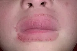 hiperkeratoza pielii - tratament, simptome, cauze (a pielii) hiperkeratoza pielii - tratament, simptomele, cauzele