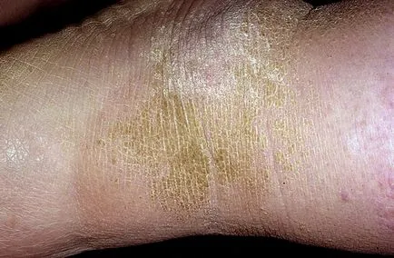 Hiperkeratoza tipurilor de piele, simptome, tratament