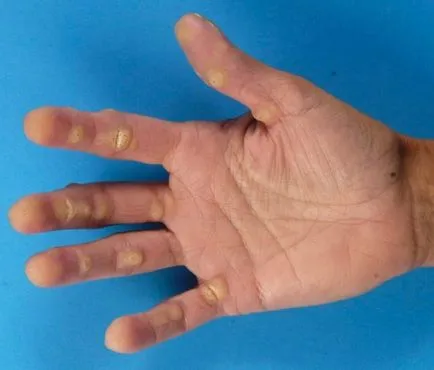 Hiperkeratoza tipurilor de piele, simptome, tratament