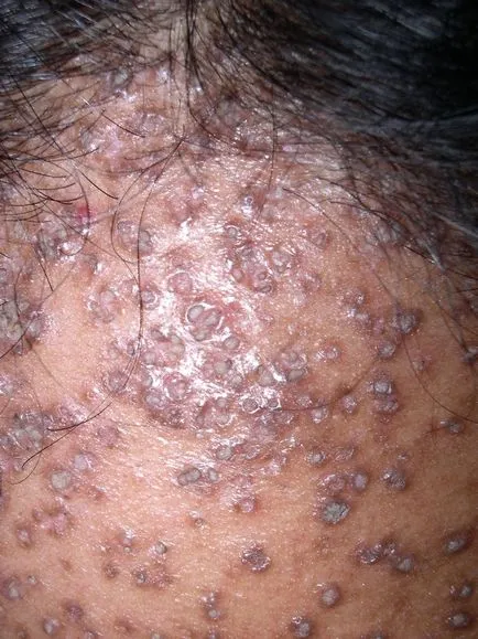 Hiperkeratoza tipurilor de piele, simptome, tratament