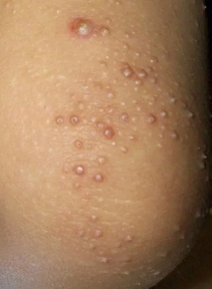 Hiperkeratoza tipurilor de piele, simptome, tratament