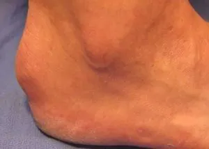 Exostosis cauze reale - simptome, tratament, prevenire (exostoze) Exostosis cauze reale - simptome, tratament, prevenire